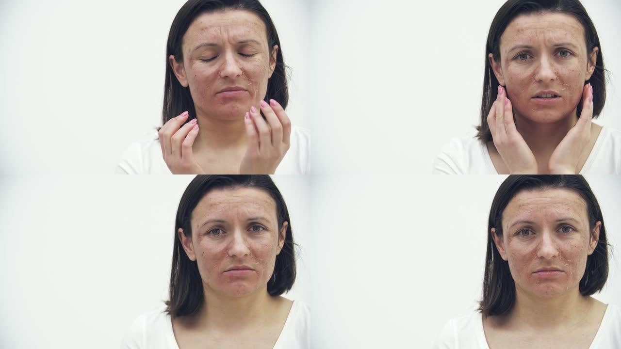 有皮肤问题的特写女性脸的4k视频。