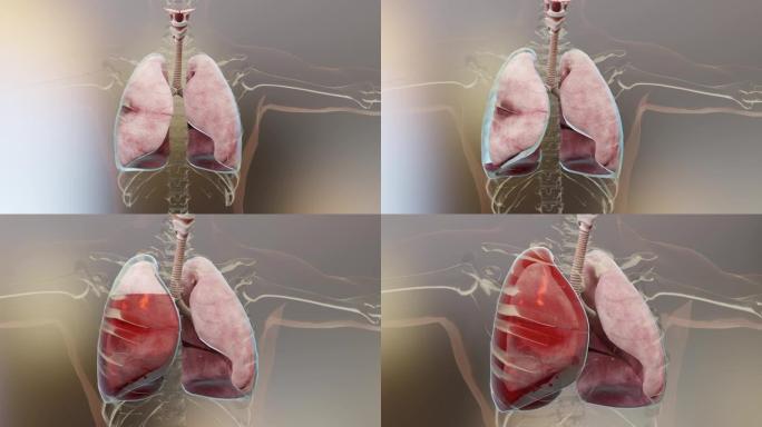 气胸，血胸和血气胸，正常肺与塌陷，气胸症状，胸腔积液，脓胸，胸部受伤后并发症，3d渲染
