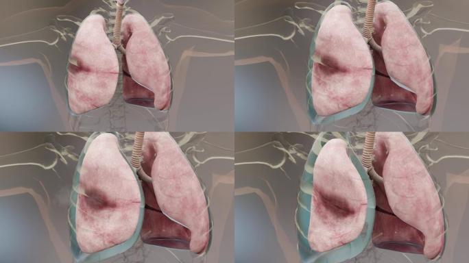 气胸，正常肺与塌陷，气胸症状，胸腔积液，脓胸，胸部受伤后并发症，肺和胸壁之间的胸膜腔中的空气，3d