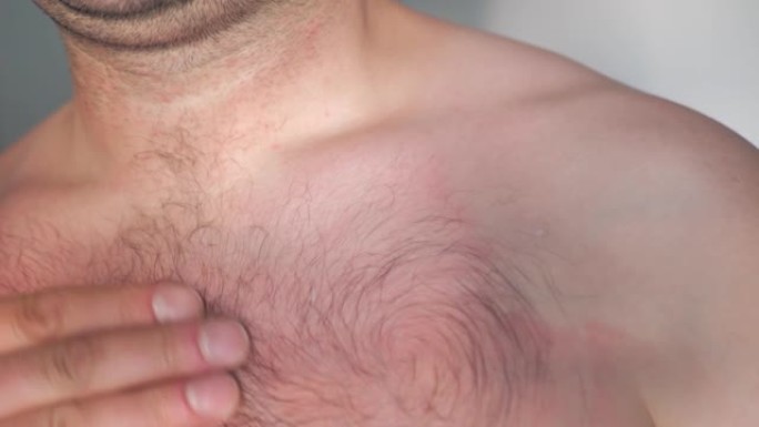 特写男士胸手涂抹舒缓润唇膏乳液，防止晒伤皮肤。