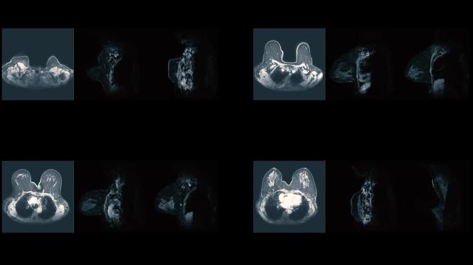 乳腺MRI或磁共振成像比较乳腺轴向和矢状位T2W