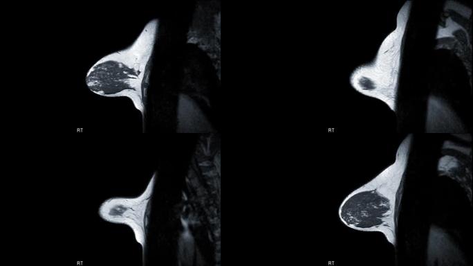 乳腺癌筛查女性乳腺MRI或磁共振成像矢状位T1W。