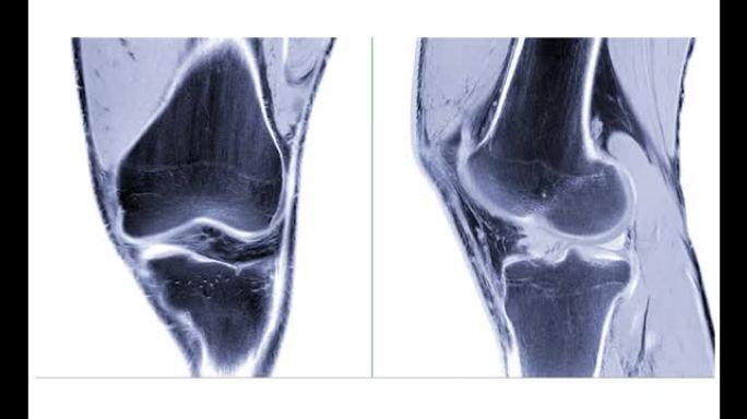 MRI膝关节或磁共振成像膝关节冠状位和矢状位视图。