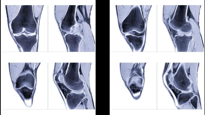 MRI膝关节或磁共振成像膝关节冠状位和矢状位视图。