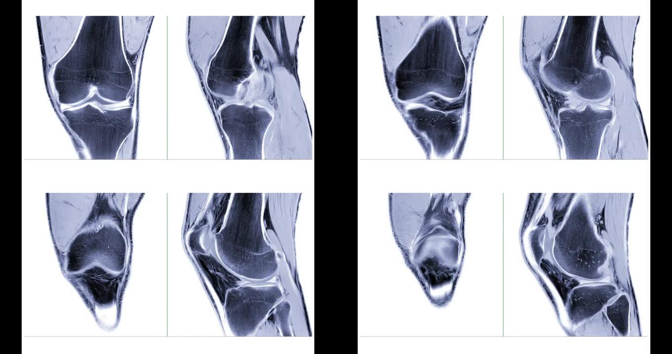 MRI膝关节或磁共振成像膝关节冠状位和矢状位视图。