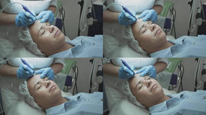 女性病人在美容师皮肤科医生的接待下。用冷冻浆和氩凝固手术抚平前额皱纹