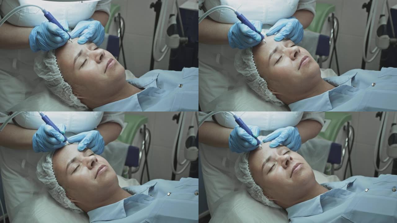 女性病人在美容师皮肤科医生的接待下。用冷冻浆和氩凝固手术抚平前额皱纹