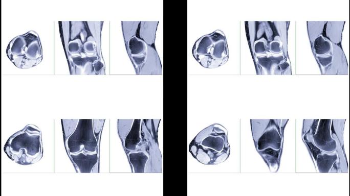 比较MRI膝关节或磁共振成像膝关节轴向、冠状面和矢状面白底对前交叉韧带 (ACL) 撕裂的诊断价值。
