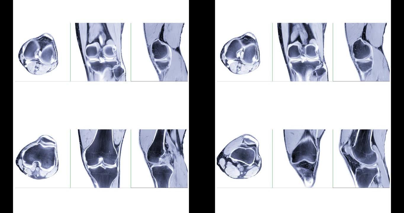 比较MRI膝关节或磁共振成像膝关节轴向、冠状面和矢状面白底对前交叉韧带 (ACL) 撕裂的诊断价值。