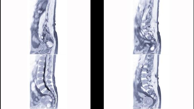 MRI在矢状面上的l-s脊柱或腰椎诊断脊髓压迫。