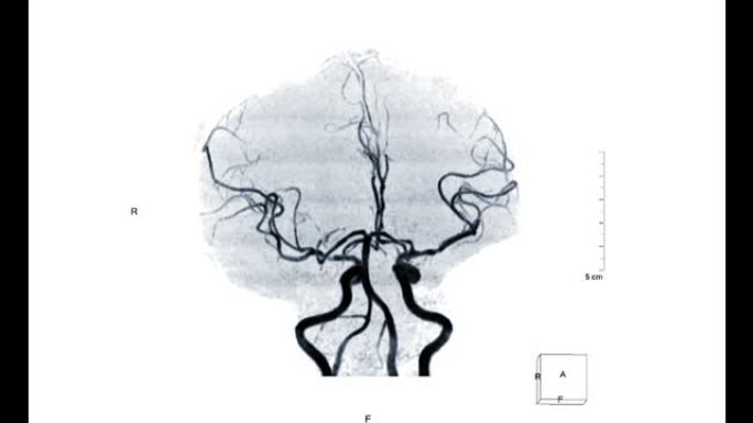 MRA脑或磁共振血管造影的脑MIP TOF技术视图显示白色背景上的脑动脉。
