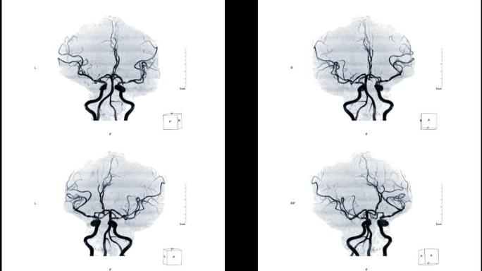 MRA脑或磁共振血管造影的脑MIP TOF技术视图显示白色背景上的脑动脉。