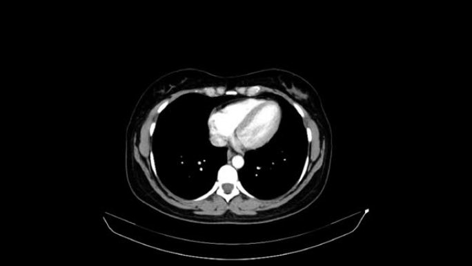 一名40岁女性的腹部和骨盆的CT与静脉对比。轴向视图。动脉期。
