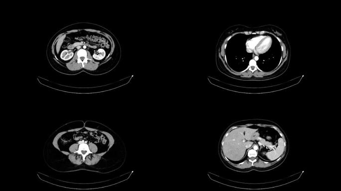 一名40岁女性的腹部和骨盆的CT与静脉对比。轴向视图。动脉期。