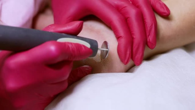 整形外科医生用圆形割刀磨脚上粗糙的皮肤。