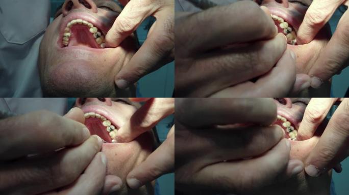 牙科植入物在牙医手中。植入手术正在进行中。钛植入物
