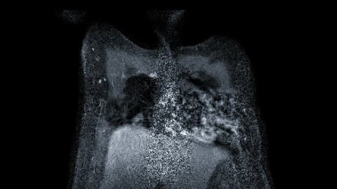 乳腺癌筛查女性乳腺MRI或磁共振冠状位T2W。