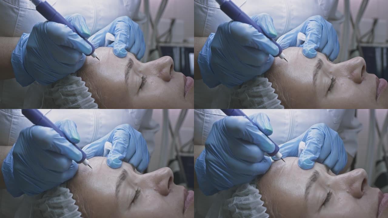 美容师皮肤科医生的女病人。用冷冻浆和氩凝固手术抚平前额皱纹