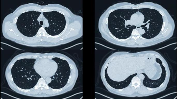CT胸部或ct扫描肺轴MIP。