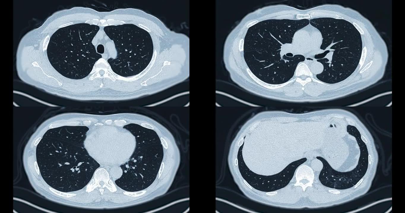 CT胸部或ct扫描肺轴MIP。