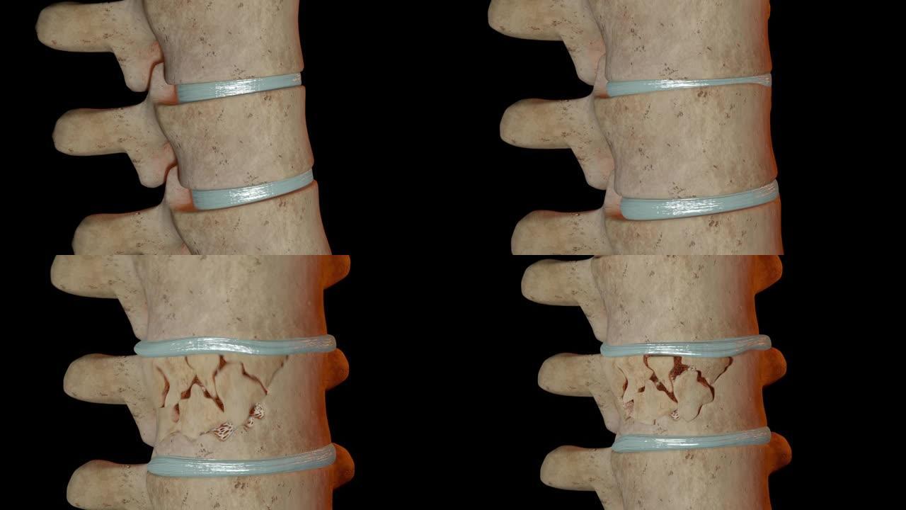 椎骨压缩性骨折