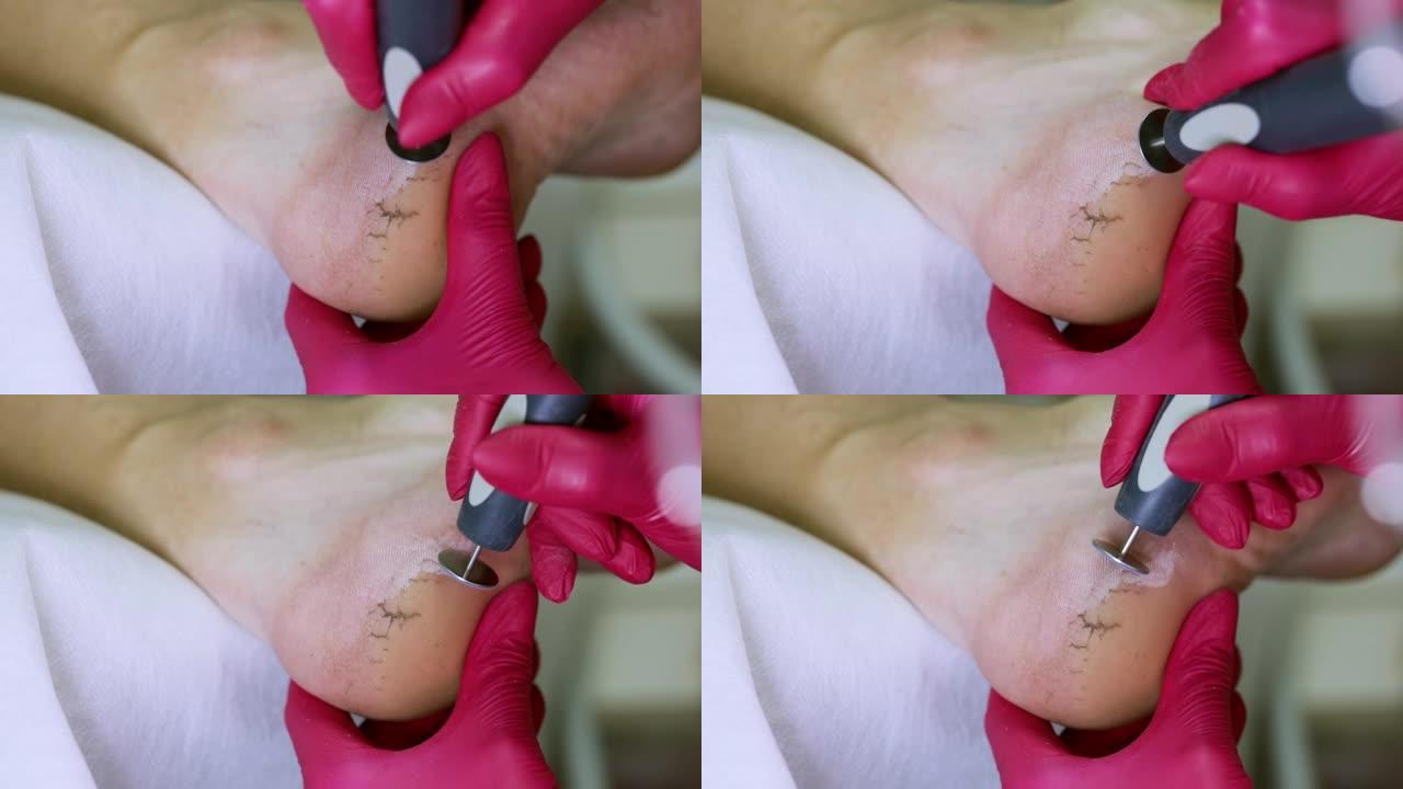 整形外科医生用圆形割刀磨脚上粗糙的皮肤。