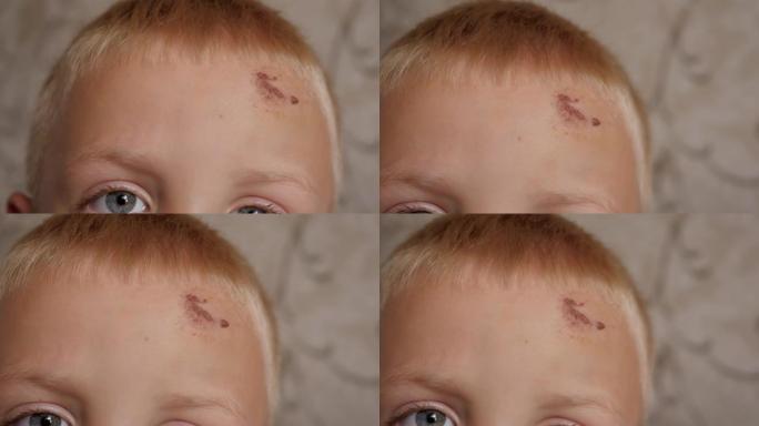 一个小男孩额头上的抓痕和肿块的特写。