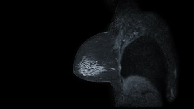 乳腺癌筛查女性乳腺MRI或磁共振成像矢状位T2W。