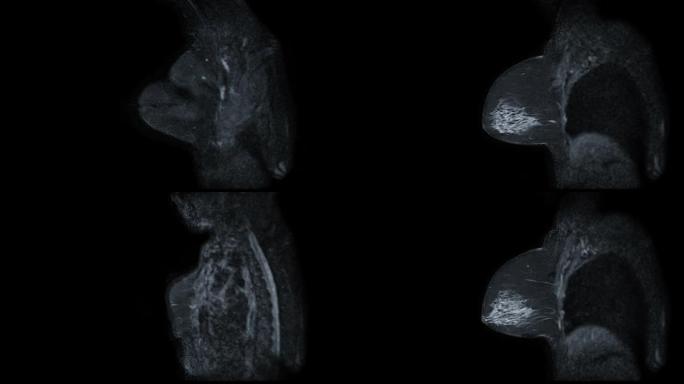 乳腺癌筛查女性乳腺MRI或磁共振成像矢状位T2W。