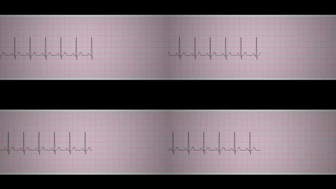 EKG窦性心动过速