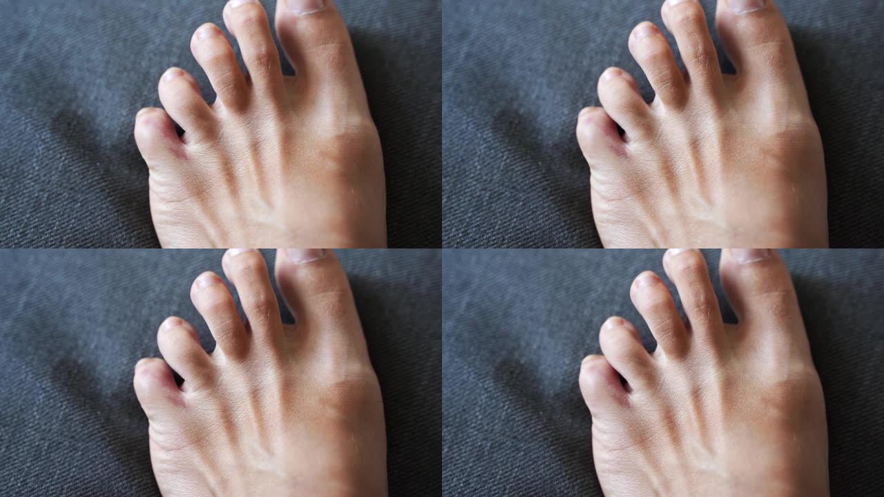 脚小指受伤。家庭事故后脚趾疼痛和瘀伤。指骨骨折。赤脚指甲健康。