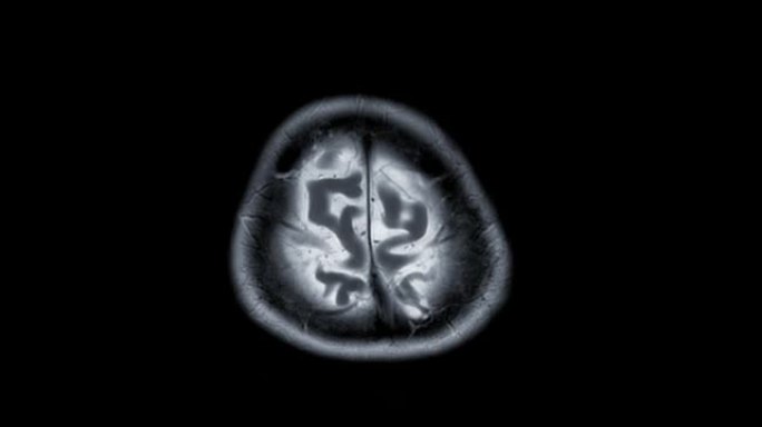 脑MRI或脑磁共振成像 (MRI) 在轴t2用于诊断中风疾病。