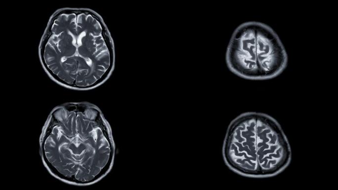 脑MRI或脑磁共振成像 (MRI) 在轴t2用于诊断中风疾病。