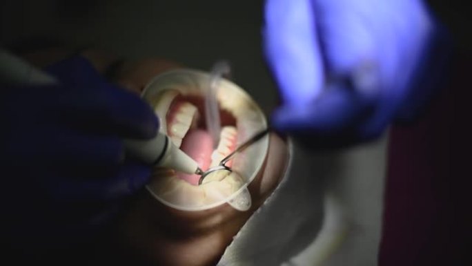 牙医用超声波对病人进行口腔卫生。