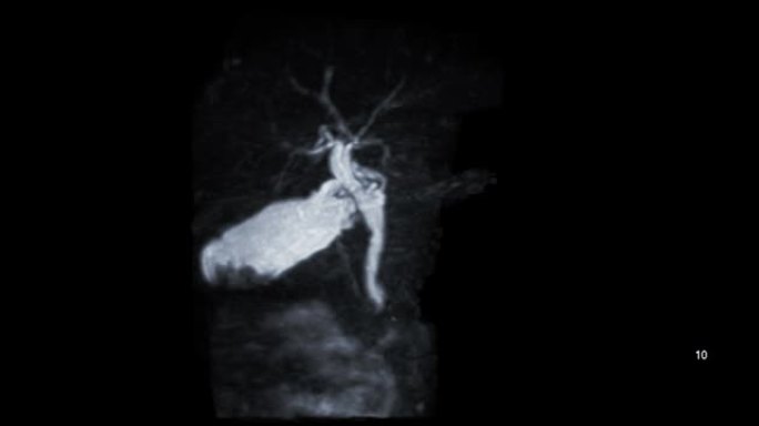 MRCP或磁共振胰胆管造影3D MIP在屏幕上显示胆管和胰管可视化。
