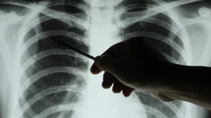 4k医生研究肋骨，肋骨-笼关节的x光片进行分析。医疗保健医院。
