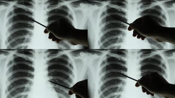 4k医生研究肋骨，肋骨-笼关节的x光片进行分析。医疗保健医院。