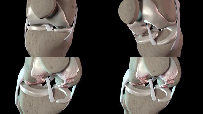 膝关节软骨损伤