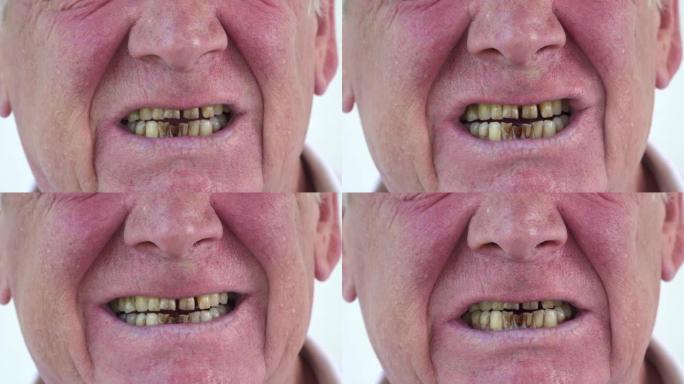 白种人的老烟嘴有染黄的坏牙齿。吸烟者生病了。吸烟者的弯曲牙齿覆盖着牙石，宏观特写。口腔卫生。专科牙医