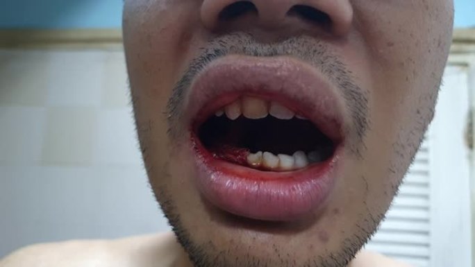 拔牙后，一个人的牙齿流血了。