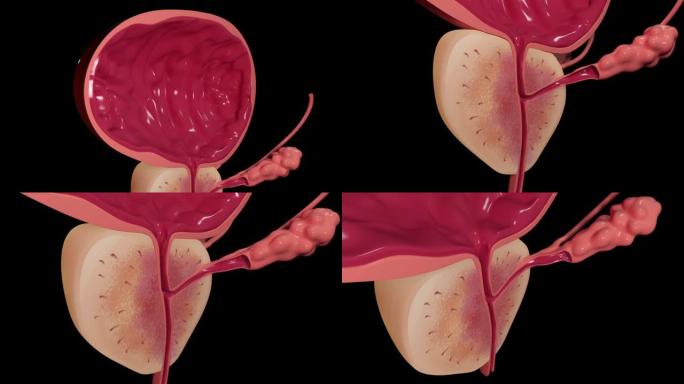 前列腺和膀胱部分
