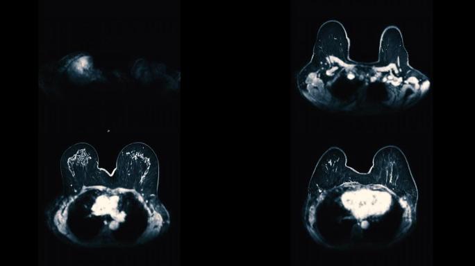 乳腺癌筛查女性的乳腺MRI或磁共振成像轴向T2W。