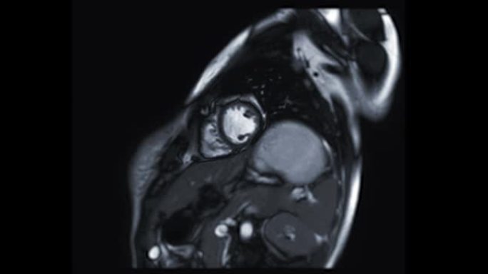 MRI心脏或心脏MRI (磁共振成像) 在短轴视图中显示心脏跳动以检测心脏病。