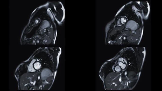 MRI心脏或心脏MRI (磁共振成像) 在短轴视图中显示心脏跳动以检测心脏病。