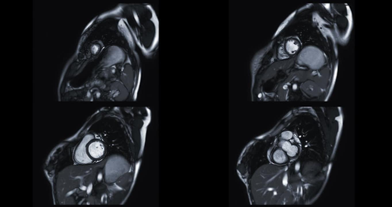 MRI心脏或心脏MRI (磁共振成像) 在短轴视图中显示心脏跳动以检测心脏病。
