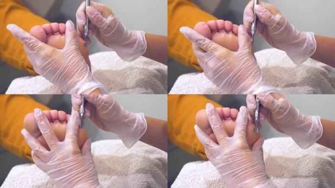 修脚师使用小的锉刀从脚底去除干燥的皮肤