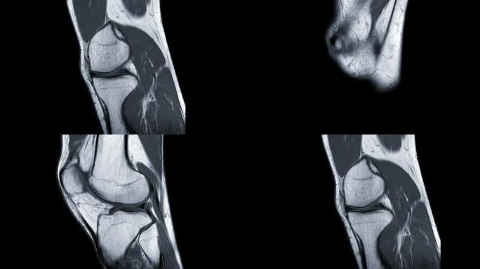 膝关节矢状面PDW的MRI膝关节或磁共振成像诊断前交叉韧带 (ACL) 撕裂