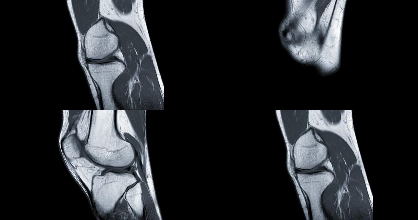 膝关节矢状面PDW的MRI膝关节或磁共振成像诊断前交叉韧带 (ACL) 撕裂