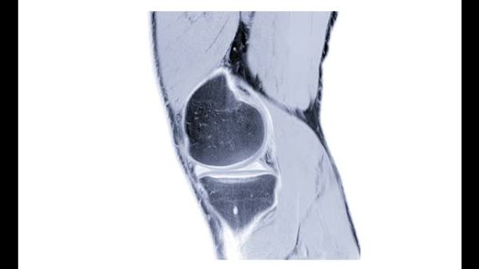 MRI膝关节或磁共振成像膝关节矢状位，用于诊断前交叉韧带 (ACL) 撕裂。