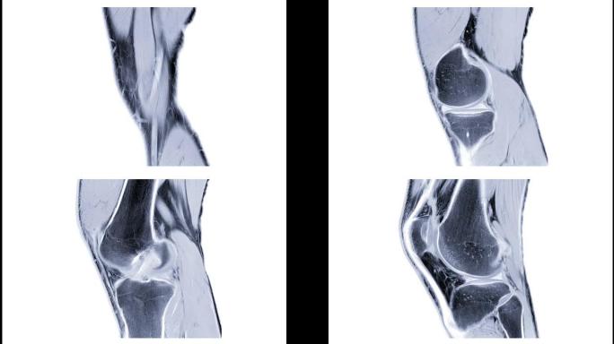 MRI膝关节或磁共振成像膝关节矢状位，用于诊断前交叉韧带 (ACL) 撕裂。